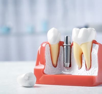 Model of dental implant in Euless, TX