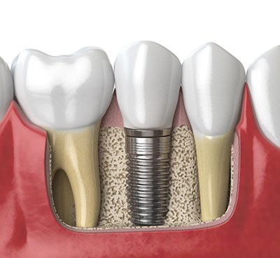 Illustration of dental implant in Euless, TX in jawbone