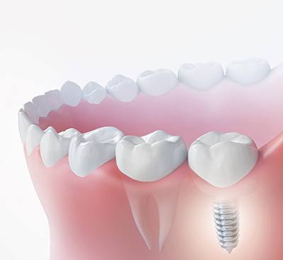 Illustration of dental implant in Euless, TX with crown