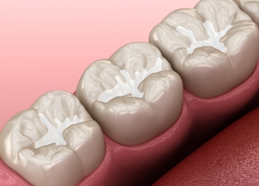 Illustrated row of teeth with barely noticeable sealants