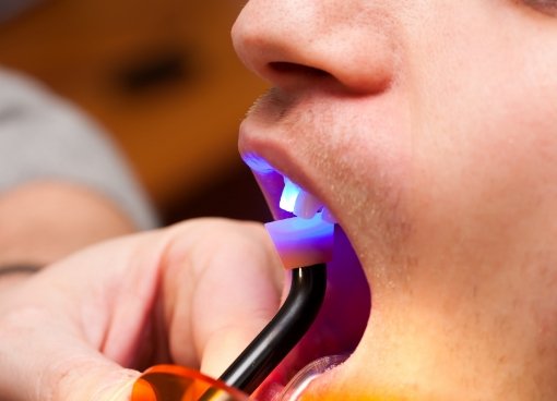Close up of dental patient having ultraviolet light shone on their tooth