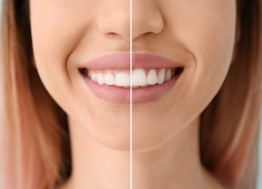 Split photo showing smile before and after gummy smile correction