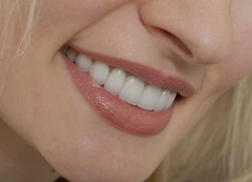 Close up of blonde woman smiling with straight white teeth