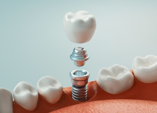 Illustrated dental implant with abutment and crown