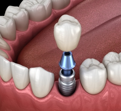 Illustrated dental crown being placed onto implant