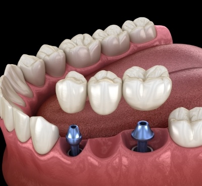 Illustrated dental bridge being placed onto two implants