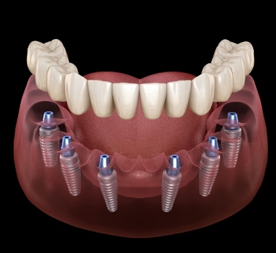 Illustrated denture being placed onto six implants