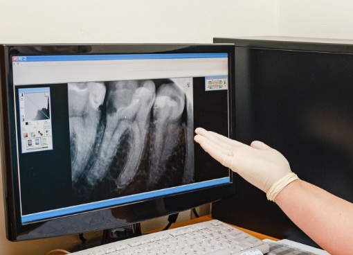 Dentist gesturing toward computer monitor showing x rays of teeth
