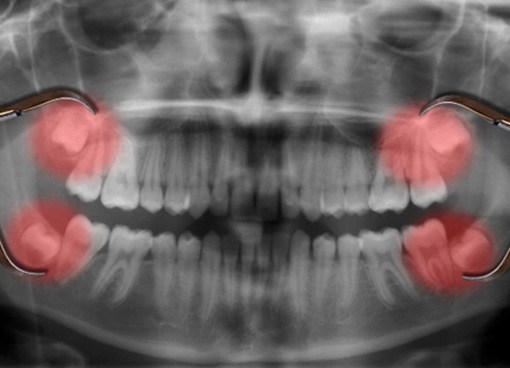 X ray showing wisdom teeth
