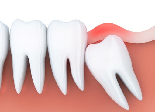 Illustration of an impacted wisdom tooth