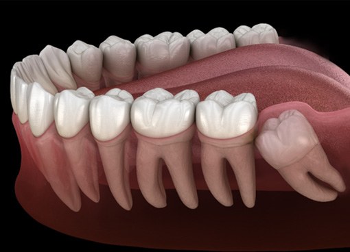 Illustration of an impacted tooth