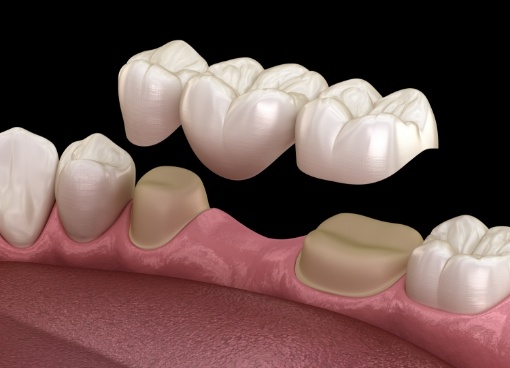 Illustrated dental bridge being fitted over two natural teeth