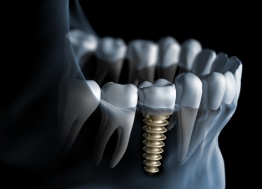 Illustrated x ray of person with dental implant