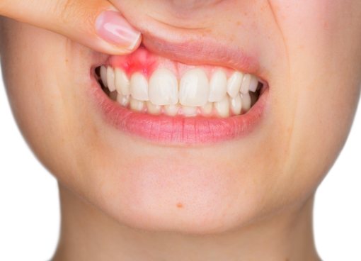 Person pointing to red spot in their gums