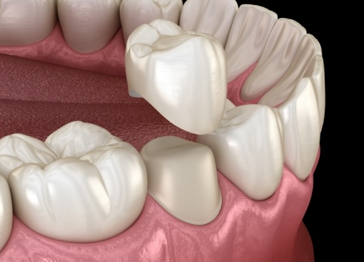 Illustrated dental crown being placed over a tooth