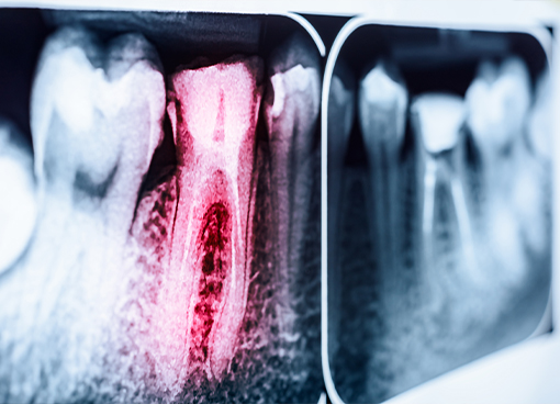 X ray of tooth highlighted red
